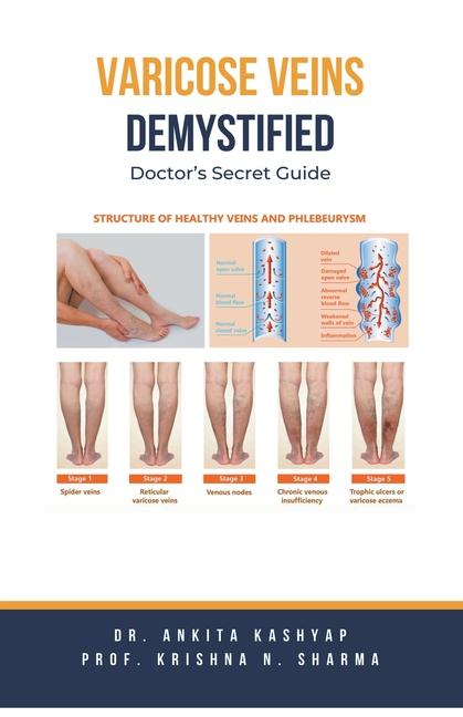 Carte Varicose Veins Demystified Krishna N. Sharma