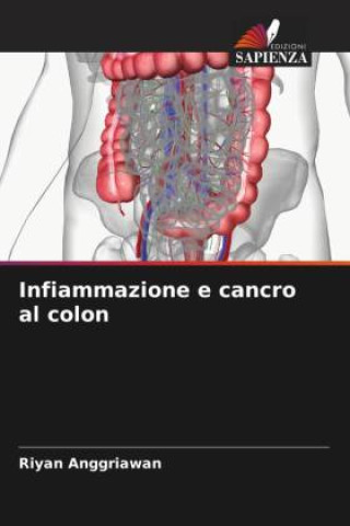 Knjiga Infiammazione e cancro al colon Riyan Anggriawan