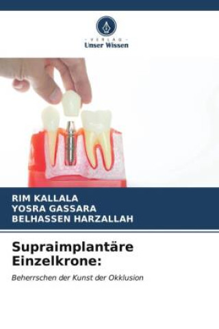 Knjiga Supraimplantäre Einzelkrone: Yosra Gassara
