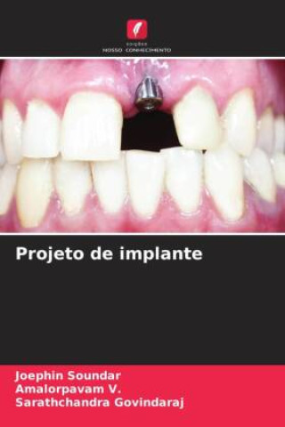 Knjiga Projeto de implante Amalorpavam V.