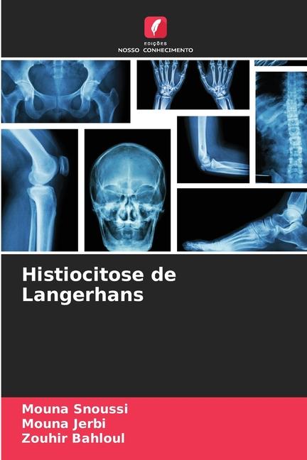 Buch Histiocitose de Langerhans Mouna Jerbi