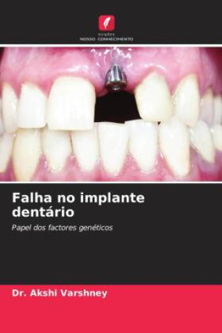 Carte Falha no implante dentário Dr. Akshi Varshney