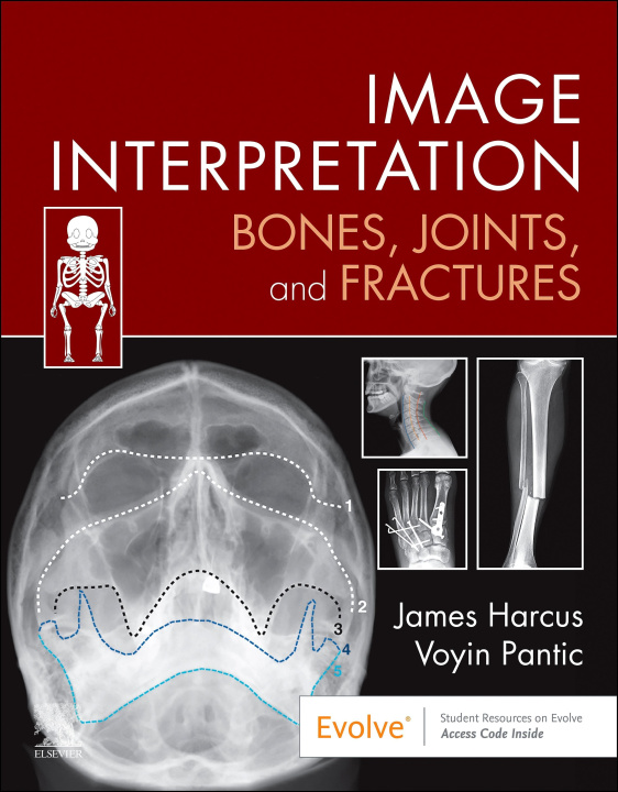 E-book Image Interpretation: Bones, Joints, and Fractures - E-Book James Harcus