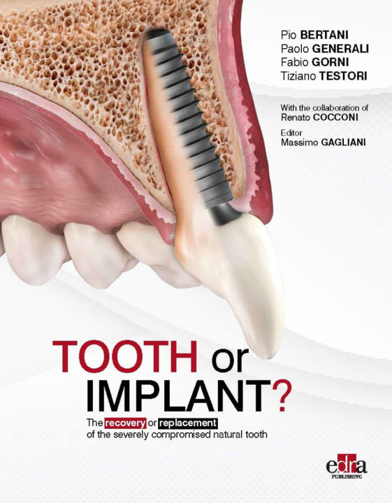 Book Tooth or Implant? The recovery or replacement of the severely compormised natural tooth Pio Bertani