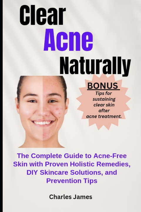 Libro Clear Acne Naturally Charles James