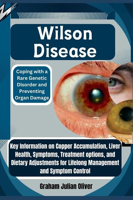 Libro Wilson Disease Graham Julian Oliver