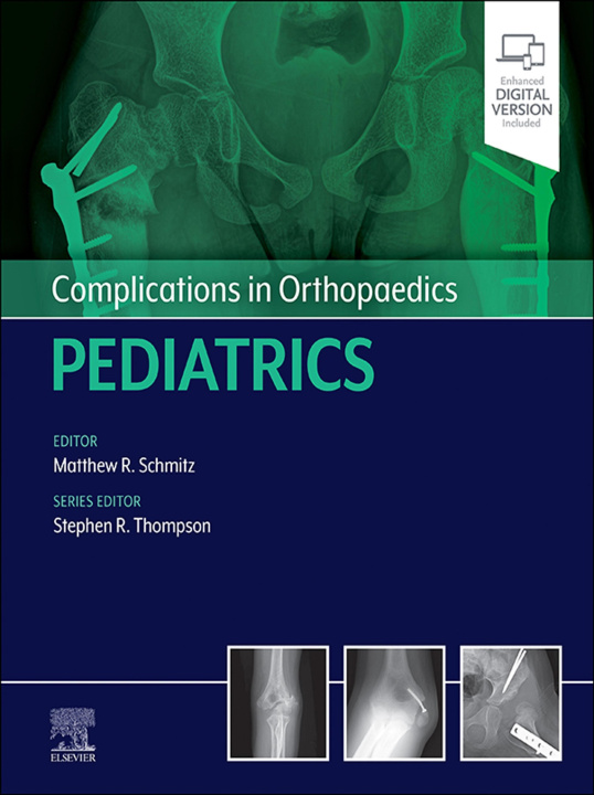 E-Book Complications in Orthopaedics: Pediatrics - E-Book Matthew Schmitz