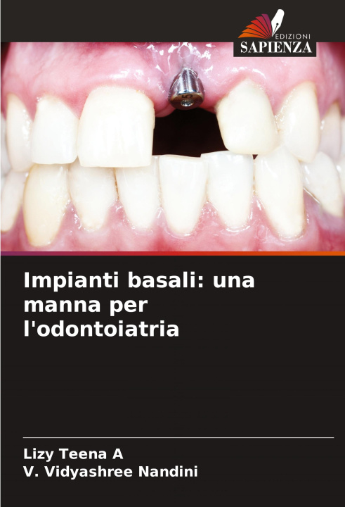 Livro Impianti basali: una manna per l'odontoiatria V. Vidyashree Nandini