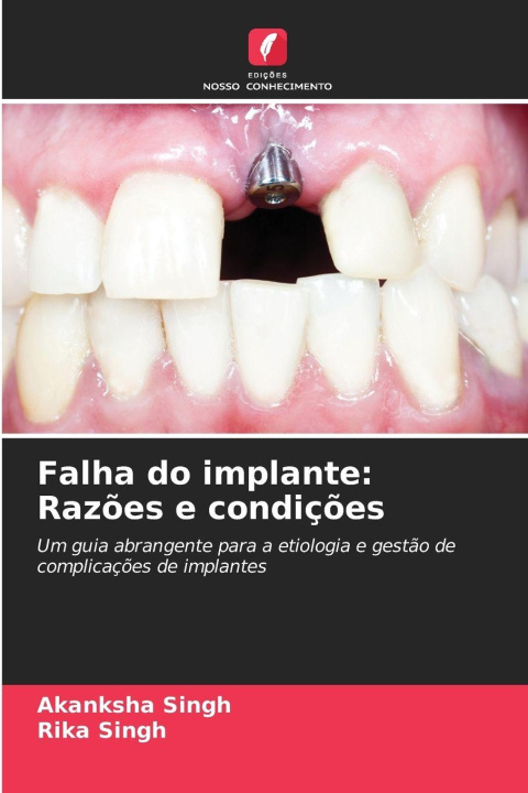 Knjiga Falha do implante: Razões e condições Rika Singh