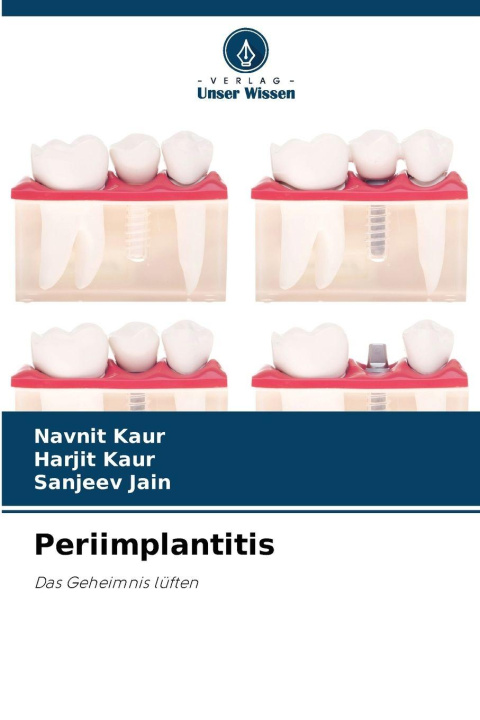 Boek Periimplantitis Navnit Kaur