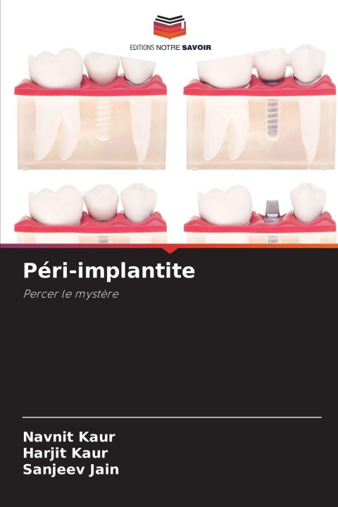 Buch Péri-implantite Navnit Kaur