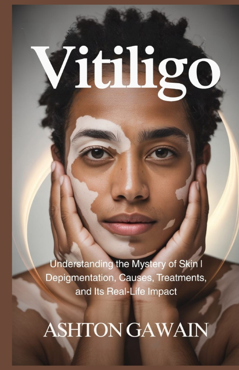 Kniha Vitiligo Ashton Gawain