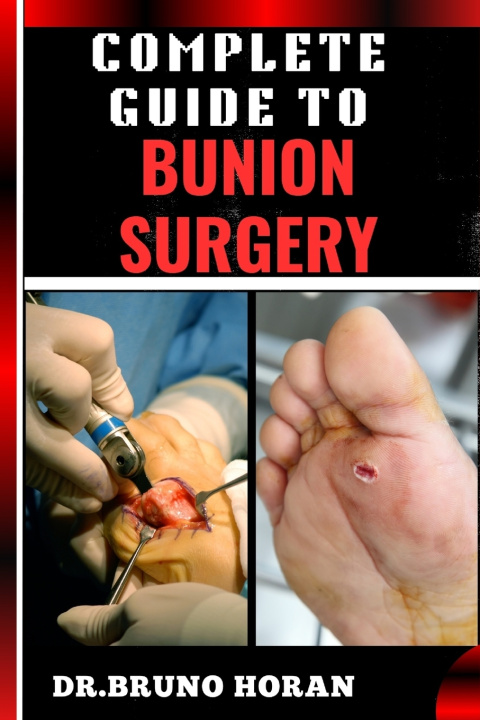 Kniha COMPLETE GUIDE TO BUNION SURGERY DR. BRUNO HORAN
