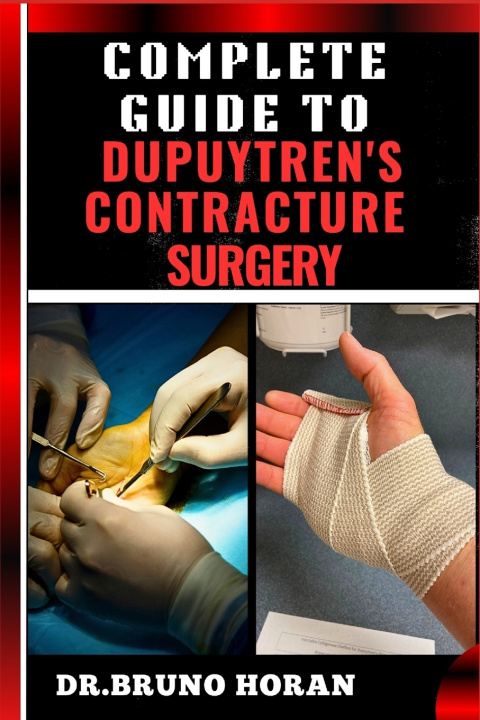 Knjiga COMPLETE GUIDE TO DUPUYTREN'S CONTRACTURE SURGERY DR. BRUNO HORAN