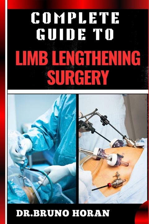 Knjiga COMPLETE GUIDE TO LIMB LENGTHENING SURGERY DR. BRUNO HORAN