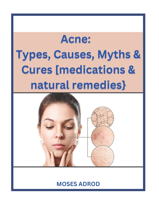 Kniha Acne Moses Adrod