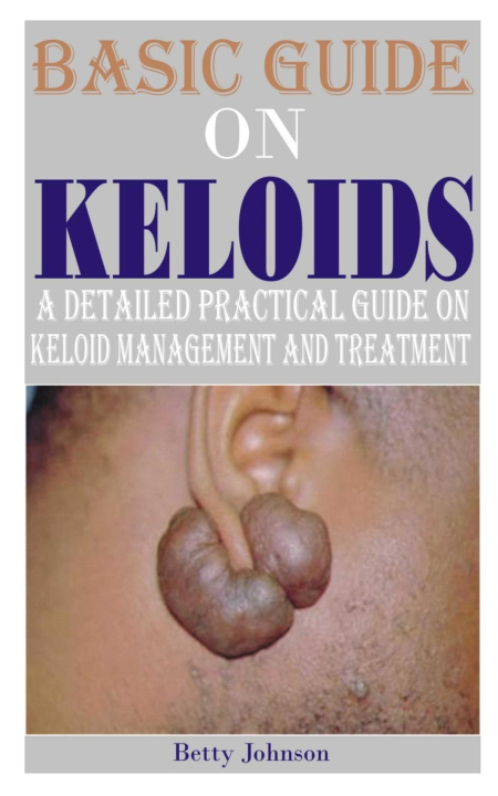 Kniha BASIC GUIDE ON KELOIDS Betty Johnson