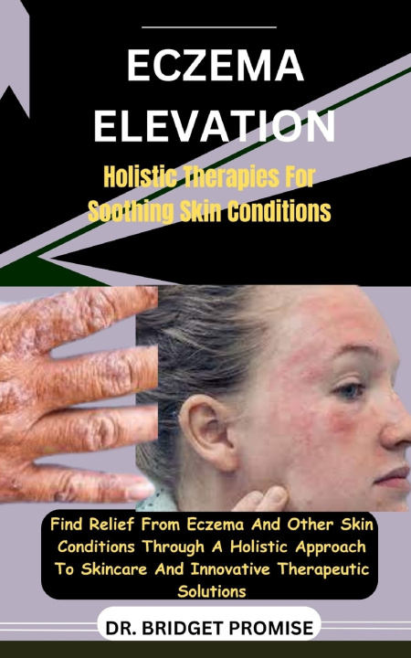 Kniha Eczema Elevation DR. BRIDGET PROMISE