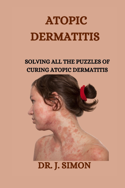 Knjiga ATOPIC DERMATITIS DR. J. SIMON