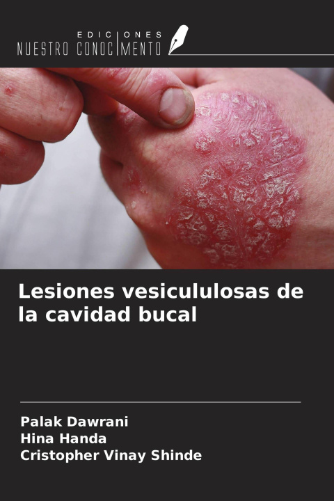 Knjiga Lesiones vesicululosas de la cavidad bucal Hina Handa