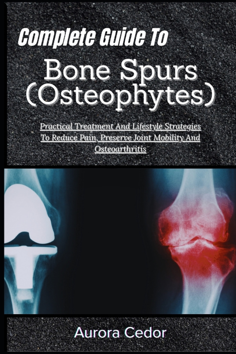 Kniha Complete Guide To Bone Spurs (Osteophytes) Aurora Cedor