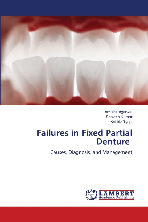 Kniha Failures in Fixed Partial Denture Amisha Agarwal