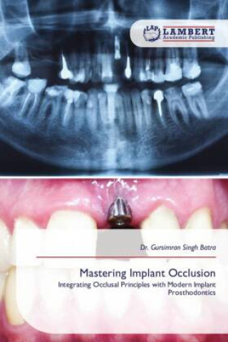 Carte Mastering Implant Occlusion Dr. Gursimran Singh Batra
