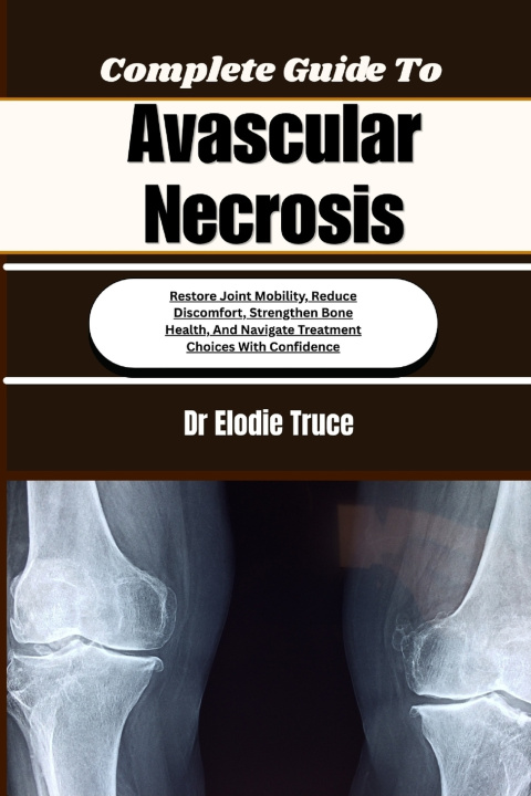 Livro Complete Guide To Avascular Necrosis Dr Elodie Truce