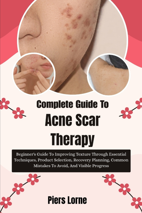 Knjiga Complete Guide To Acne Scar Therapy Piers Lorne